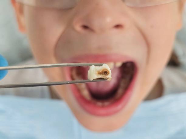 Best Emergency Dental Care for Broken or Chipped Teeth in Port Royal, SC